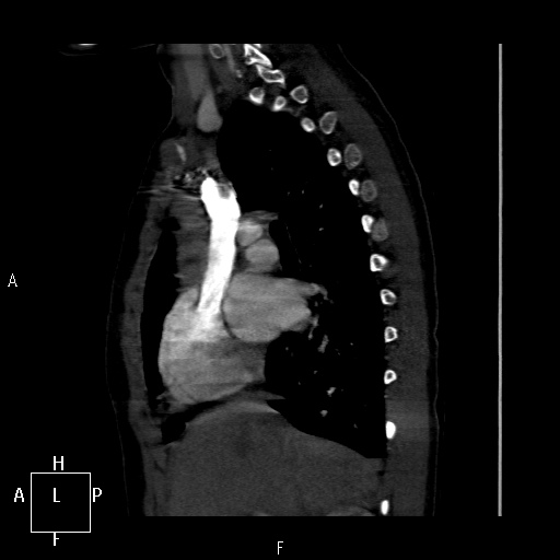 File:Aortopulmonary septal defect (Radiopaedia 41990-45013 Sagittal C+ CTPA 38).jpg