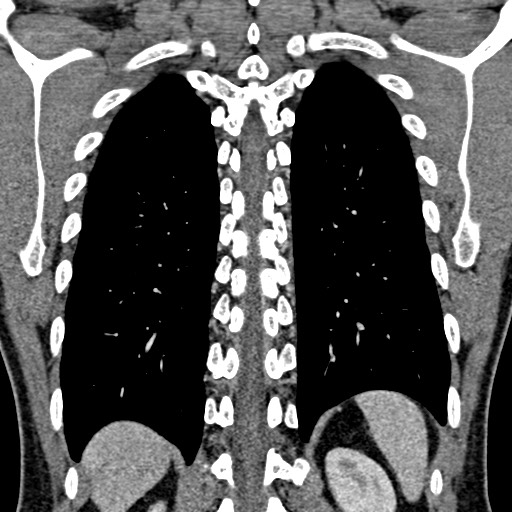 Apical lung mass mimic - neurogenic tumor (Radiopaedia 59918-67521 B 84).jpg