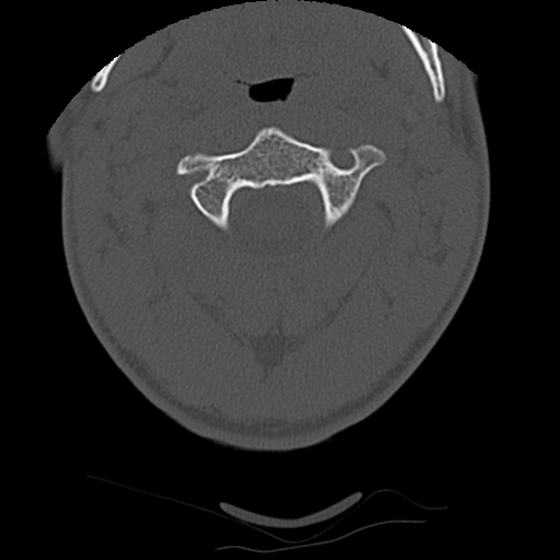 Apical pneumothorax on cervical spine CT (Radiopaedia 45343-49368 Axial bone window 23).jpg