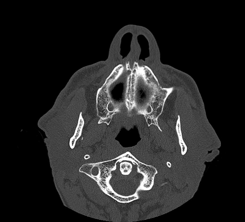 Aplastic maxillary sinuses (Radiopaedia 60030-67561 Axial non-contrast 14).jpg