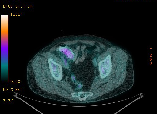 File:Appendiceal adenocarcinoma complicated by retroperitoneal abscess (Radiopaedia 58007-65041 Axial PET-CT 175).jpg