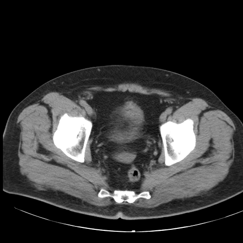 Appendicitis and giant appendicolith (Radiopaedia 80251-93588 Axial non-contrast 53).jpg