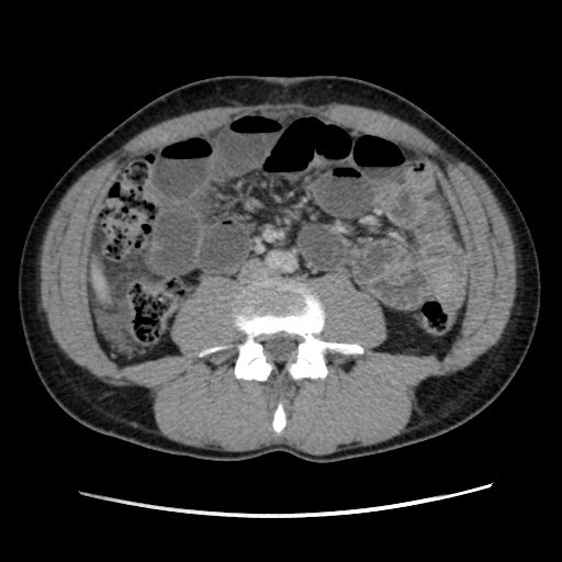 File:Appendicitis complicated by post-operative collection (Radiopaedia 35595-37114 A 47).jpg