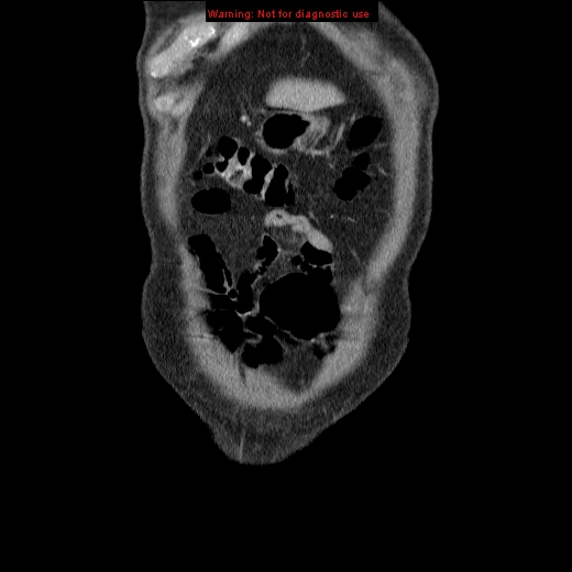 File:Appendicitis mass in inguinal hernia (Radiopaedia 26858-27029 B 2).jpg