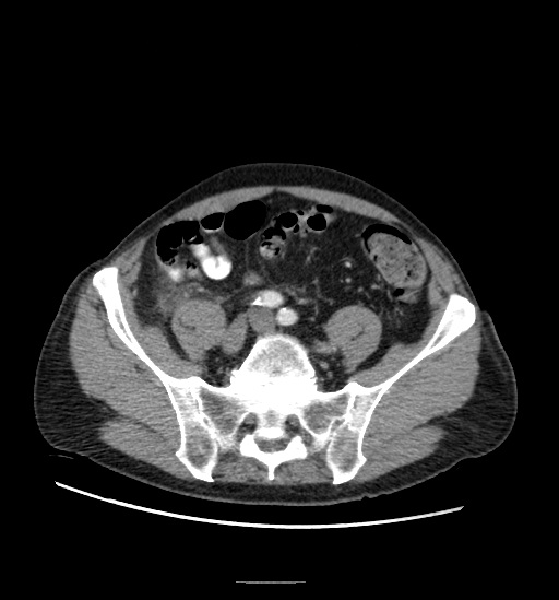 Appendicitis with localized perforation and abscess formation (Radiopaedia 49035-54130 A 65).jpg
