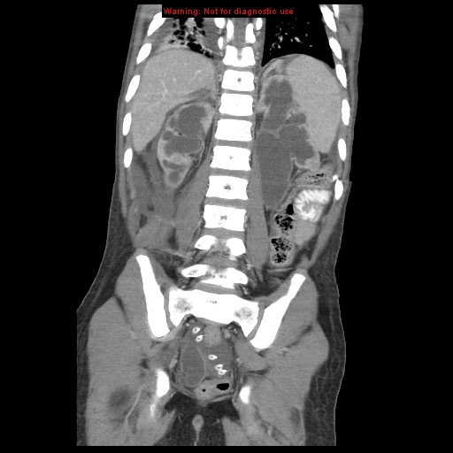 Appendicitis with phlegmon (Radiopaedia 9358-10046 B 51).jpg