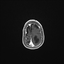 Aqueductal stenosis (Radiopaedia 73974-84802 Axial T1 C+ 133).jpg