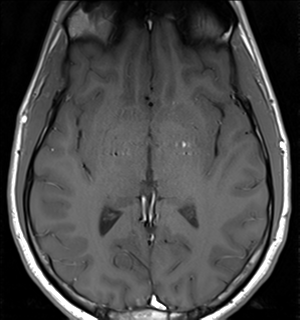 File:Arachnoid cyst - cerebellopontine angle (Radiopaedia 59689-67083 Axial T1 23).png