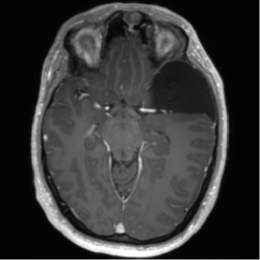 Arachnoid cyst with subdural hematoma (Radiopaedia 85892-101743 Axial T1 C+ 38).png