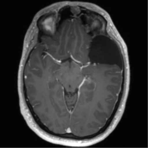 Arachnoid cyst with subdural hematoma (Radiopaedia 85892-101743 Axial T1 C+ 39).png