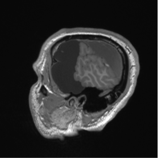 Arachnoid cyst with subdural hematoma (Radiopaedia 85892-101743 Sagittal T1 16).png