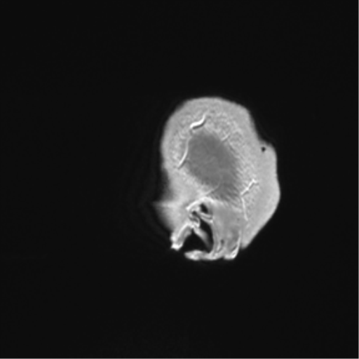 Arachnoid cyst with subdural hematoma (Radiopaedia 85892-101743 Sagittal T1 C+ 90).png