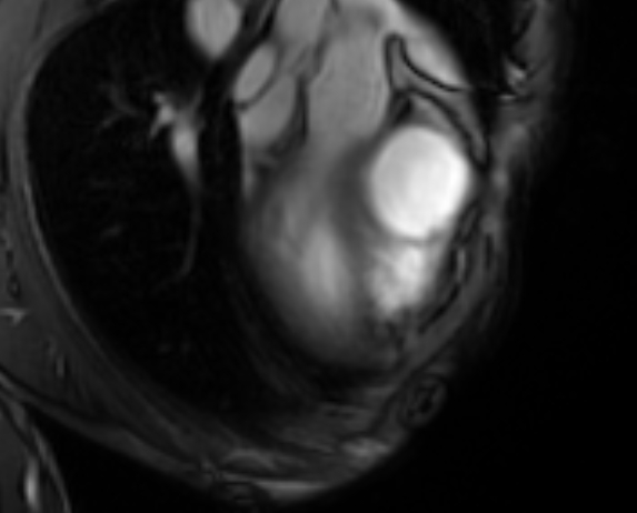 Arrhythmogenic right ventricular cardiomyopathy (Radiopaedia 69564-79464 4ch cine 8).jpg