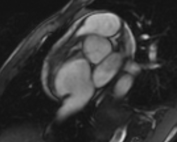 Arrhythmogenic right ventricular cardiomyopathy (Radiopaedia 69564-79464 short axis cine 270).jpg