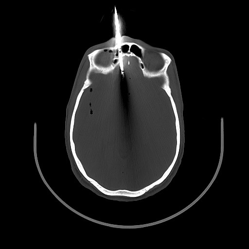 Arrow injury to the brain (Radiopaedia 72101-82607 Axial bone window 69).jpg