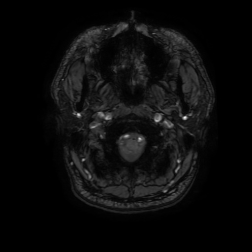 Arteriovenous malformation (Radiopaedia 71628-81999 Axial Gradient Echo 3).jpg