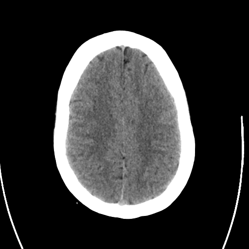 File:Arteriovenous malformation (cerebral) (Radiopaedia 40070-42579 Axial non-contrast 24).png