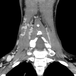Arteriovenous malformation of the neck (Radiopaedia 53935-60062 D 28).jpg