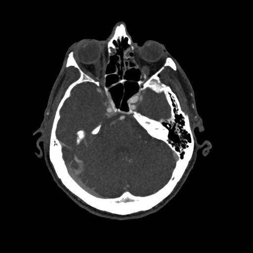 Artery of Percheron infarct (Radiopaedia 48088-52894 A 120).jpg