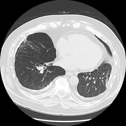 Asbestos-related pleural disease (Radiopaedia 74366-85250 Axial lung window 76).jpg