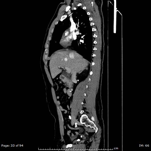 File:Ascending aortic aneurysm (Radiopaedia 50086-55404 C 24).jpg