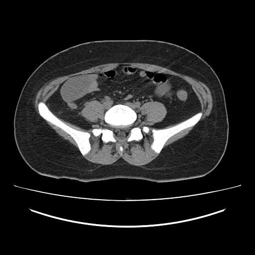 Ascending retrocecal appendicitis with liver abscesses (Radiopaedia 60066-67615 Axial non-contrast 58).jpg