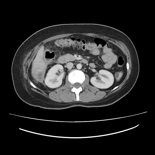 Ascending retrocecal appendicitis with liver abscesses (Radiopaedia 60066-67615 B 40).jpg