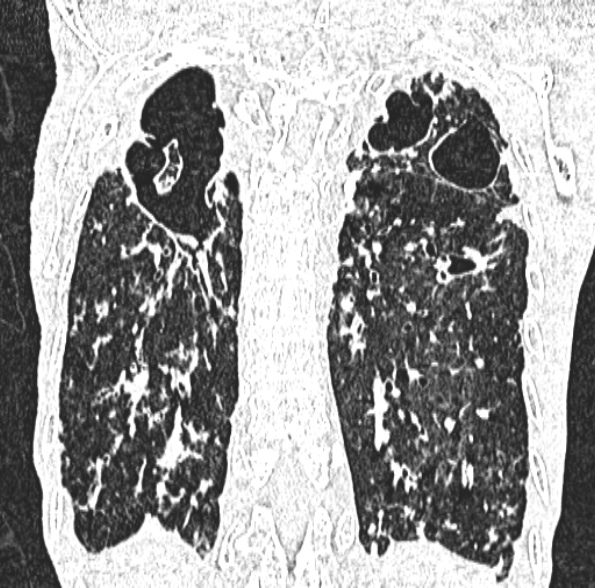 Aspergilloma- with Monod sign (Radiopaedia 44737-48532 Coronal lung window 349).jpg