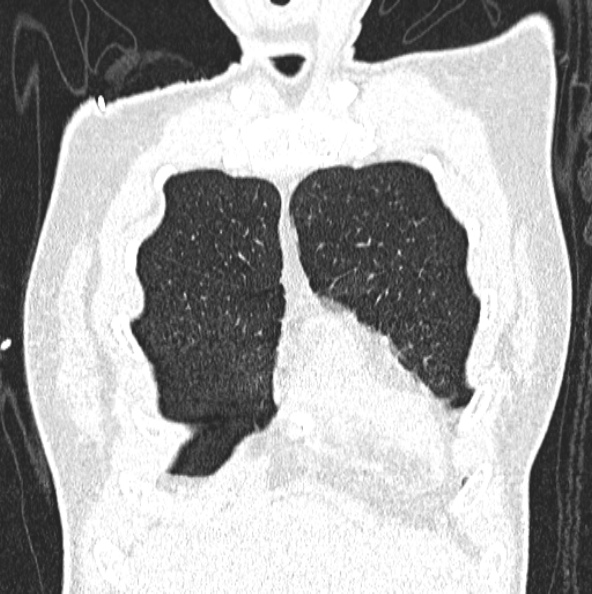File:Aspergilloma (Radiopaedia 26223-26347 Coronal lung window 9).jpg