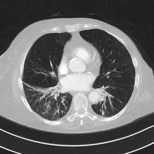 Aspiration bronchiolitis (Radiopaedia 53464-59463 Axial lung window 33).png