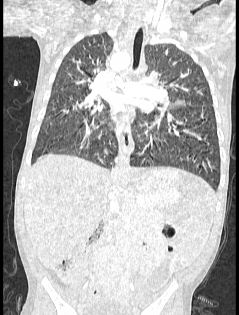 Asplenia syndrome (Radiopaedia 73083-83792 Coronal lung window 79).jpg
