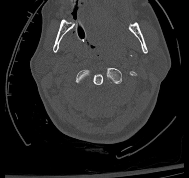 Atlanto-axial subluxation-dislocation (Radiopaedia 29659-30185 Axial bone window 30).jpg