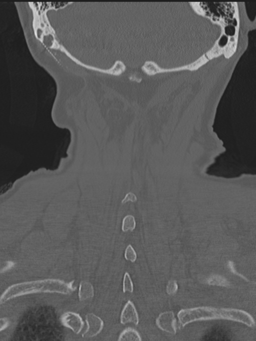 Atlanto-axial subluxation (Radiopaedia 36610-38176 Coronal bone window 43).png