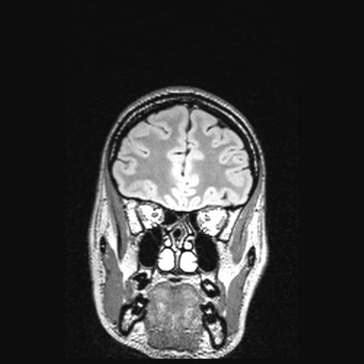 File:Atretic encephalocoele with inferior vermis hypoplasia (Radiopaedia 30443-31108 Coronal FLAIR 140).jpg