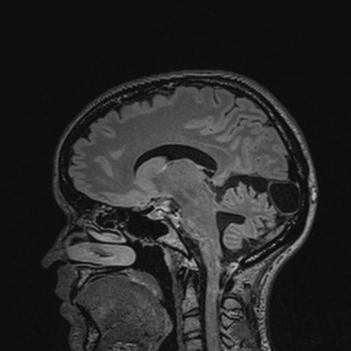Atretic encephalocoele with inferior vermis hypoplasia (Radiopaedia 30443-31108 Sagittal FLAIR 89).jpg