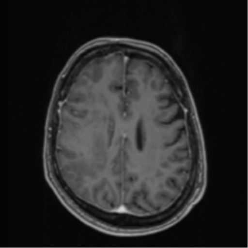 Atypical meningioma (WHO Grade II) (Radiopaedia 54742-60979 Axial T1 C+ 46).png