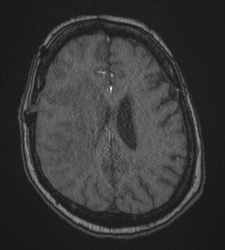 Atypical meningioma (WHO Grade II) (Radiopaedia 54742-60981 Axial MRA 67).png