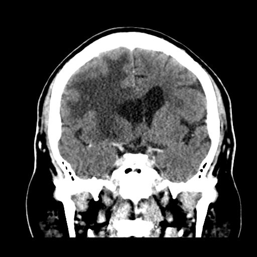 Atypical meningioma (WHO grade II) with brain invasion (Radiopaedia 57767-64728 Coronal C+ 28).png