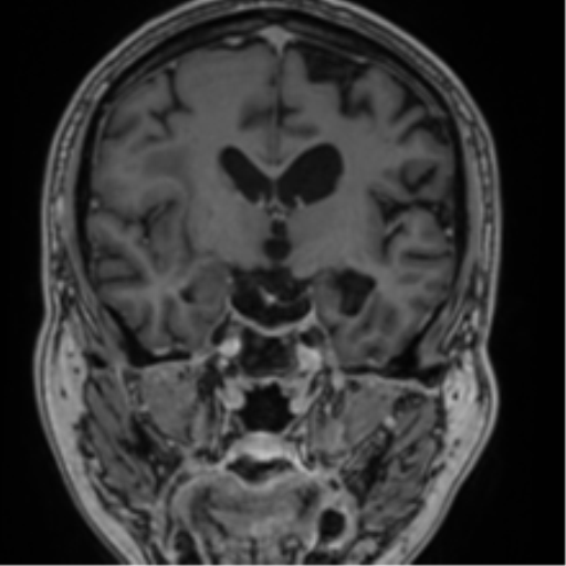Atypical meningioma (WHO grade II) with brain invasion (Radiopaedia 57767-64729 Coronal T1 C+ 41).png