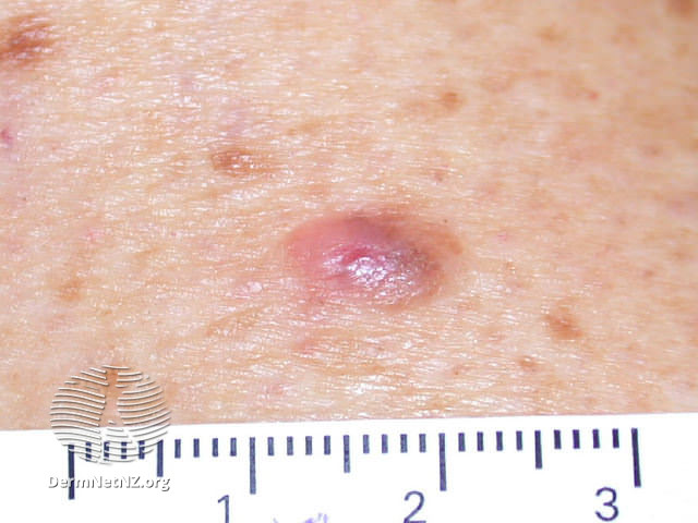 File:Atypical naevus (DermNet NZ lesions-atypical-naevi-587).jpg