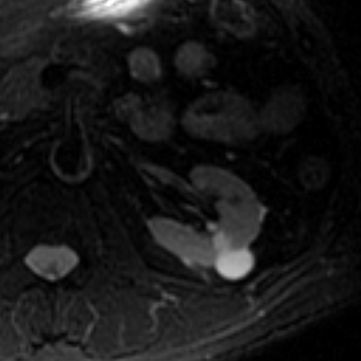 File:Atypical renal cyst on MRI (Radiopaedia 17349-17046 Axial T2 fat sat 11).jpg