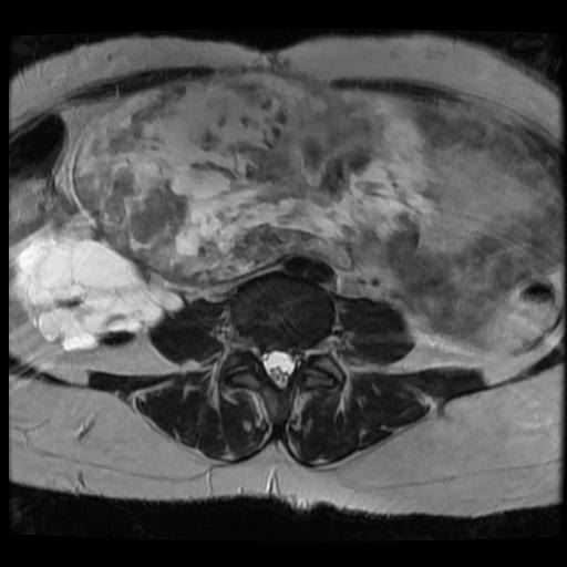 File:Atypical retroperitoneal lymphocoeles with large leiomyoma of uterus (Radiopaedia 32084-33027 Axial T2 6).jpg