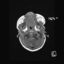 Atypical teratoid rhabdoid tumor (prenatal US and neonatal MRI) (Radiopaedia 59091-66388 Axial T1 9).jpg