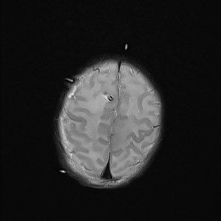 File:Atypical teratoid rhabdoid tumor (prenatal US and neonatal MRI) (Radiopaedia 59091-66388 Axial T2 25).jpg