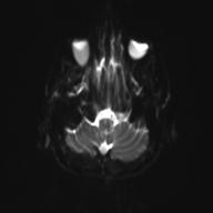 Autoimmune limbic encephalitis (Radiopaedia 30363-31005 Axial B0 and DWI 7).jpg