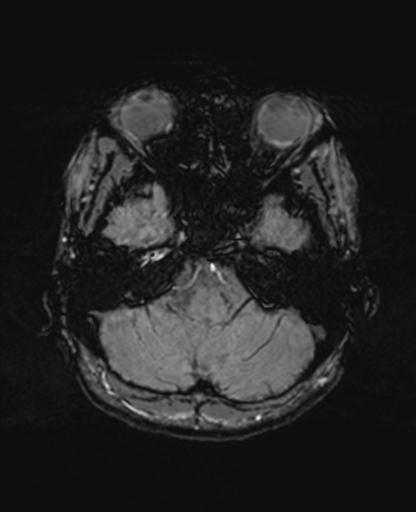Autoimmune limbic encephalitis (Radiopaedia 30363-31005 SWI 15).jpg