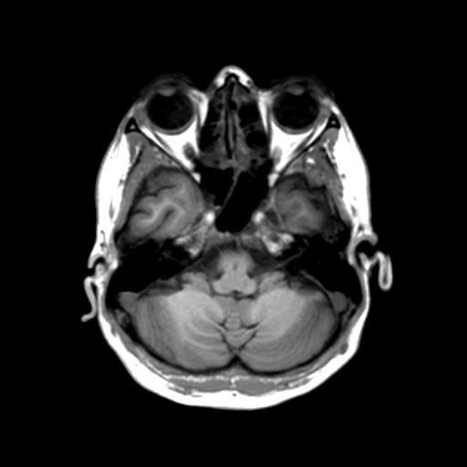 Autoimmune limbic encephalitis (Radiopaedia 30363-31005 T1 Axial 3mm 13).jpg