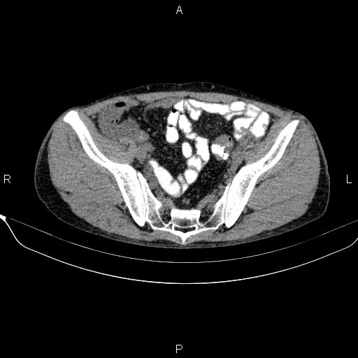 Autoimmune pancreatitis (Radiopaedia 84925-100431 Axial non-contrast 45).jpg
