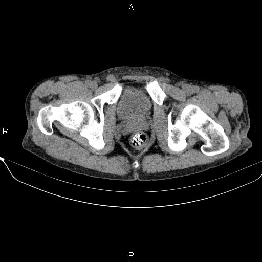 Autoimmune pancreatitis (Radiopaedia 84925-100431 Axial non-contrast 56).jpg