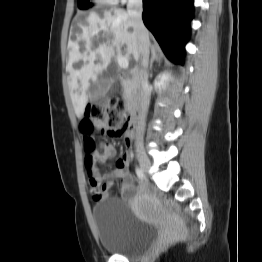 Autosomal dominant polycystic kidney disease (Radiopaedia 23061-23093 F 23).jpg